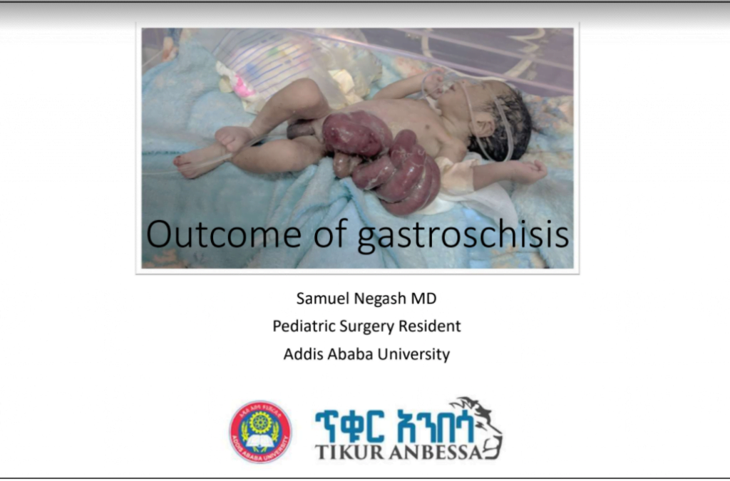 gastroschisis