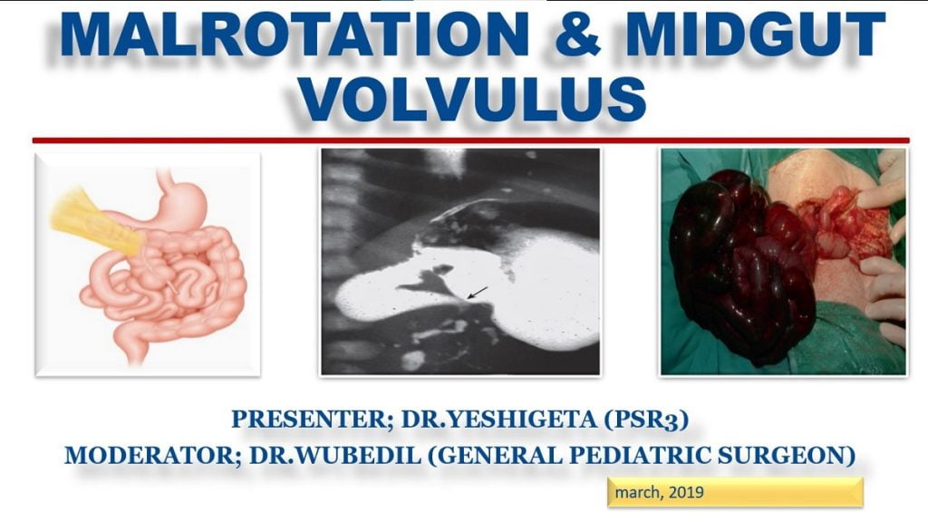 Malrotation and midgut volvulus