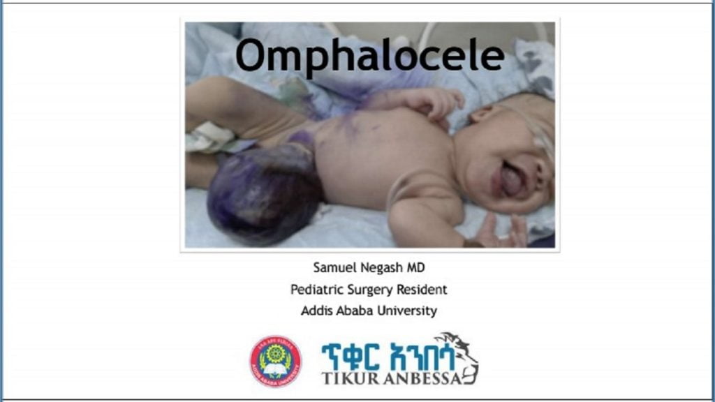 omphalocele